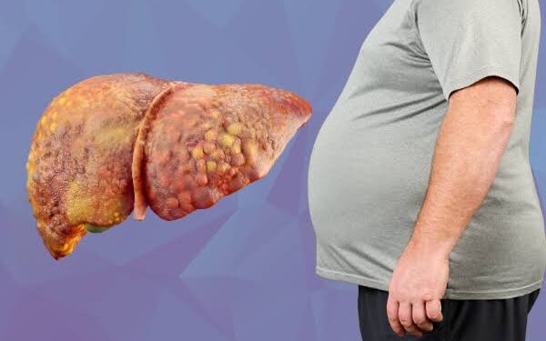 ‘Fatty Liver’ வராமல் தடுக்க என்ன செய்ய வேண்டும்? – கல்லீரலைக் காக்க வாழ்க்கை முறையில் தேவைப்படும் மாற்றங்கள்