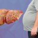 ‘Fatty Liver’ வராமல் தடுக்க என்ன செய்ய வேண்டும்? – கல்லீரலைக் காக்க வாழ்க்கை முறையில் தேவைப்படும் மாற்றங்கள்